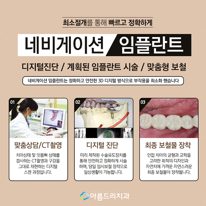 치아인플란트 네비게이션인플란트의 안전함 관련 이미지 4