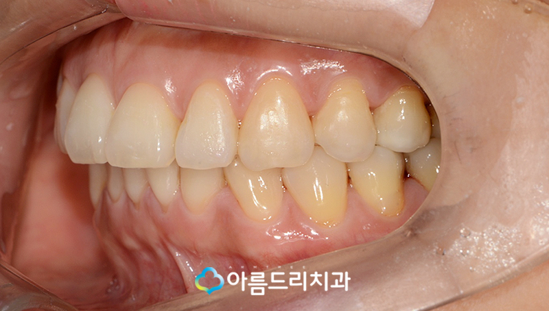 드라큘라이빨 송곳니교정 부분교정후기 관련 이미지 10