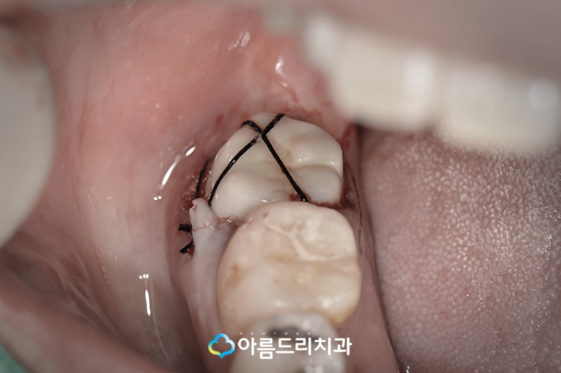 치아재식술 자연치아를지키는 방법 관련 이미지 10