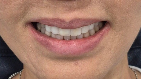 테일러 비니어 (진료일기) 관련 이미지 11