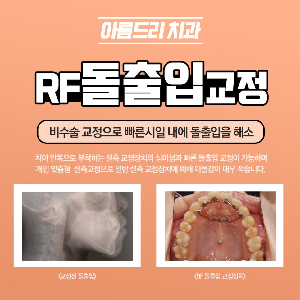 돌출입교정전후 새롭게 태어남 관련 이미지 5