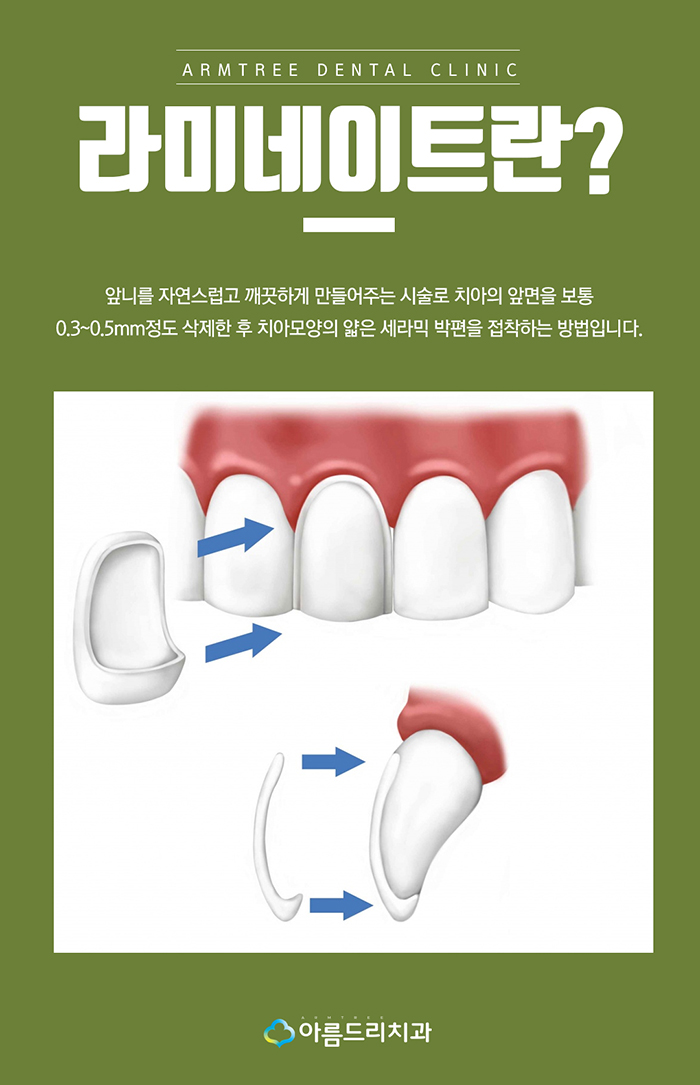 토끼이빨라미네이트 눈깜짝할 사이에 관련 이미지 2