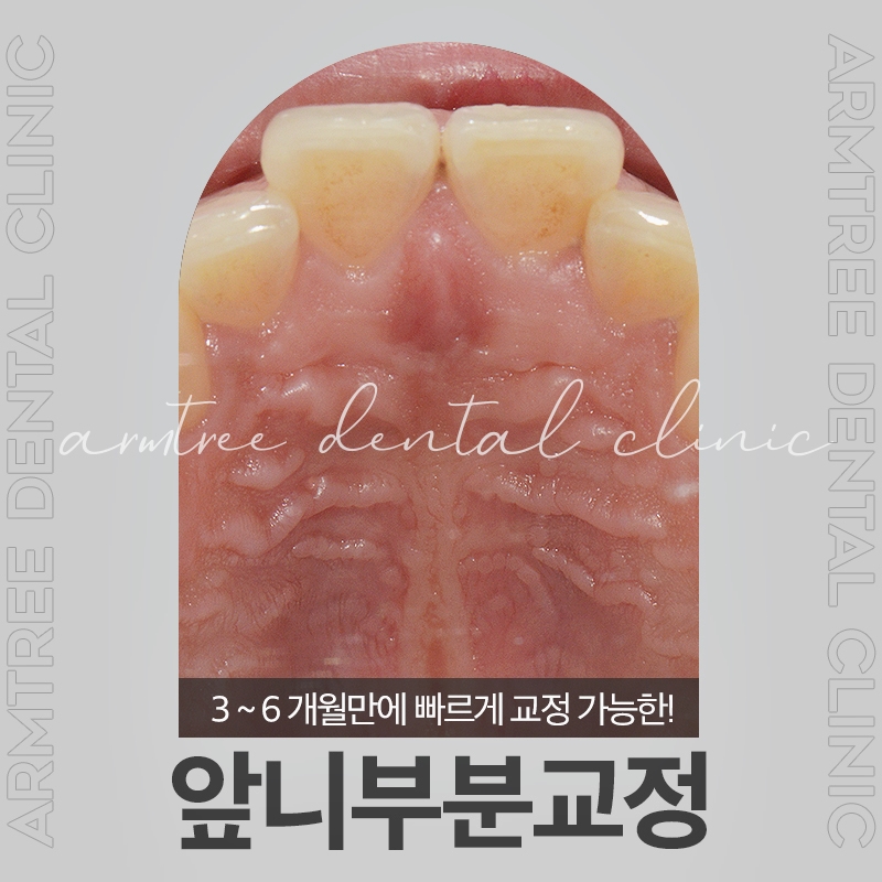 돌출앞니부분교정은 신논현역 아름드리치과에서 관련 이미지 1