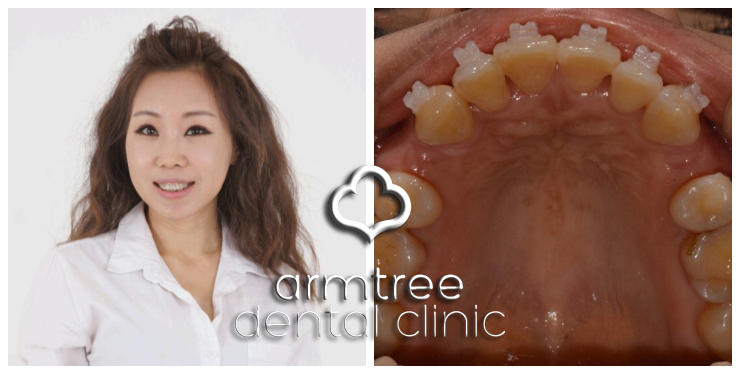 이현정원장의 아름다운 당신 시즌 1(4회 박효남 도전자) 돌출입 치아교정 관련 이미지 11