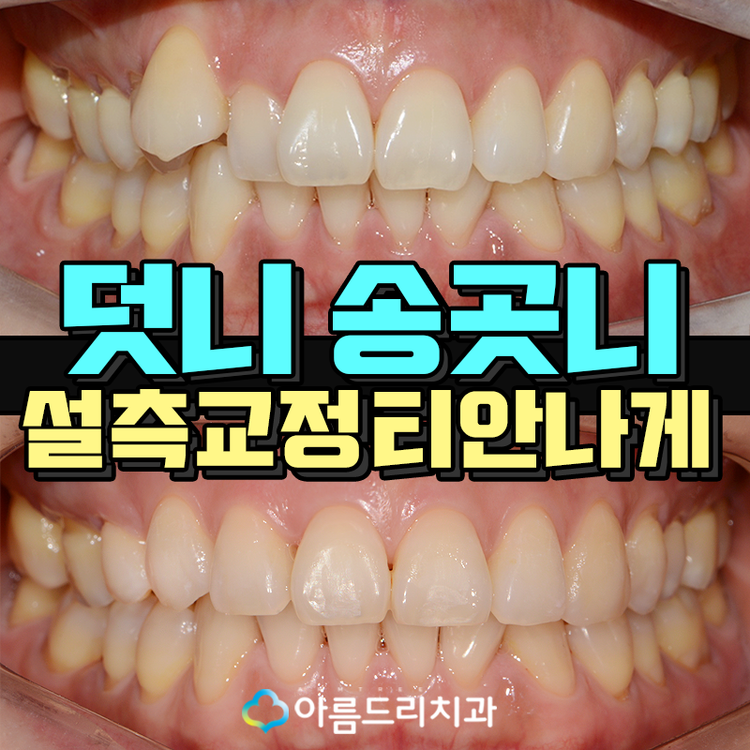 설측교정 후기앞니 단기간에 관련 이미지 1