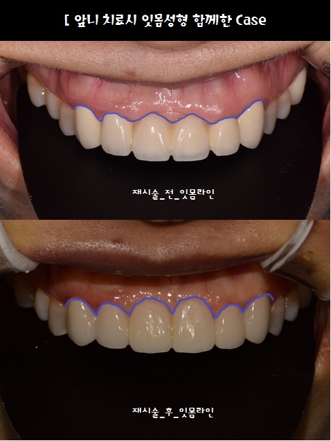 앞니 크라운 재치료 & 잇몸성형 _건강하게 . 예뻐지는 방법 관련 이미지 10