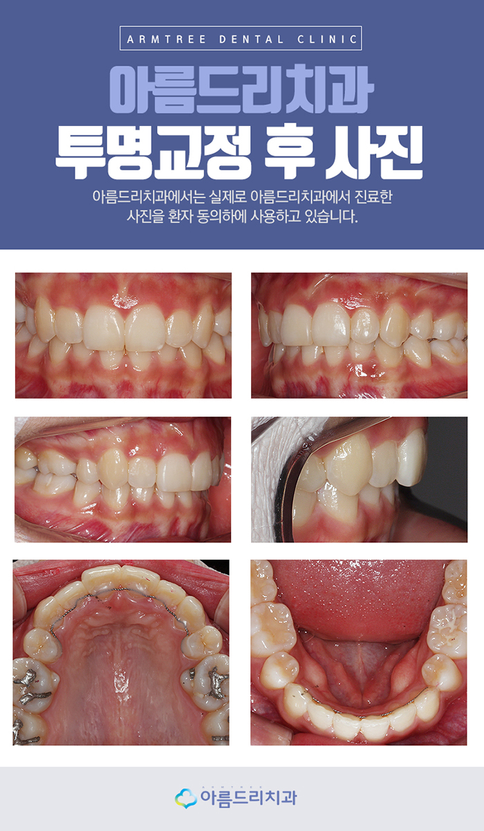 연예인투명교정 놀라워 관련 이미지 6