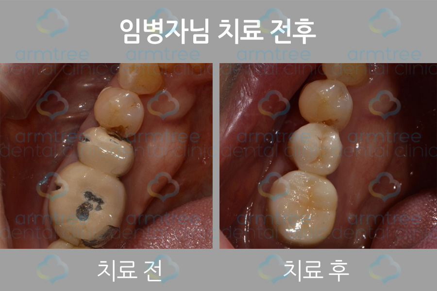 이현정 원장의 아름다운 당신 시즌 1 (11회 임병자 도전자) 신경치료, 보철치료 관련 이미지 2