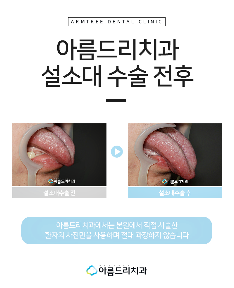 설소대단축증 - 단설소대증의 치료과정 관련 이미지 9