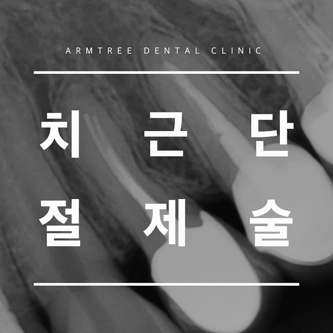 치근단절제술 염증 신뢰있는 후기 아름드리치과 관련 이미지 1