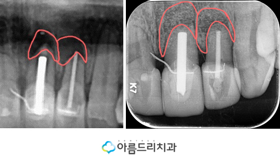 치근단절제술 수술후기 자연치아 살리기 관련 이미지 10