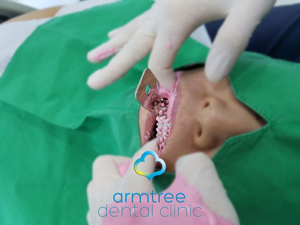 아름드리치과 이현정원장의 치료 이야기- 라미네이트란? 관련 이미지 6