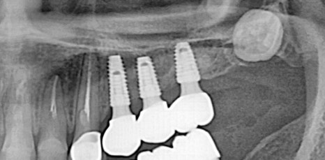신논현역임플란트 아름드리치과에서 상악동거상술이 필요하면 관련 이미지 13