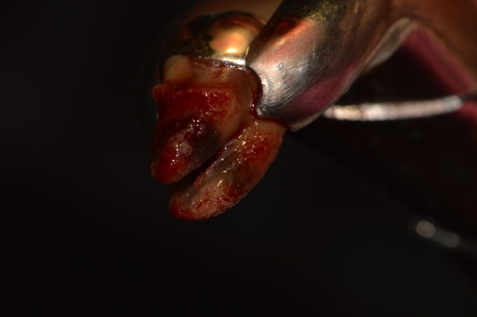 [신논현 치과] 임플란트 대신 치아재식(아름드리치과) 관련 이미지 6