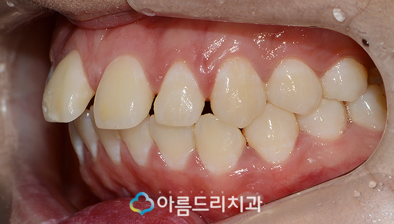 라미네이트부작용 걱정은노 관련 이미지 4