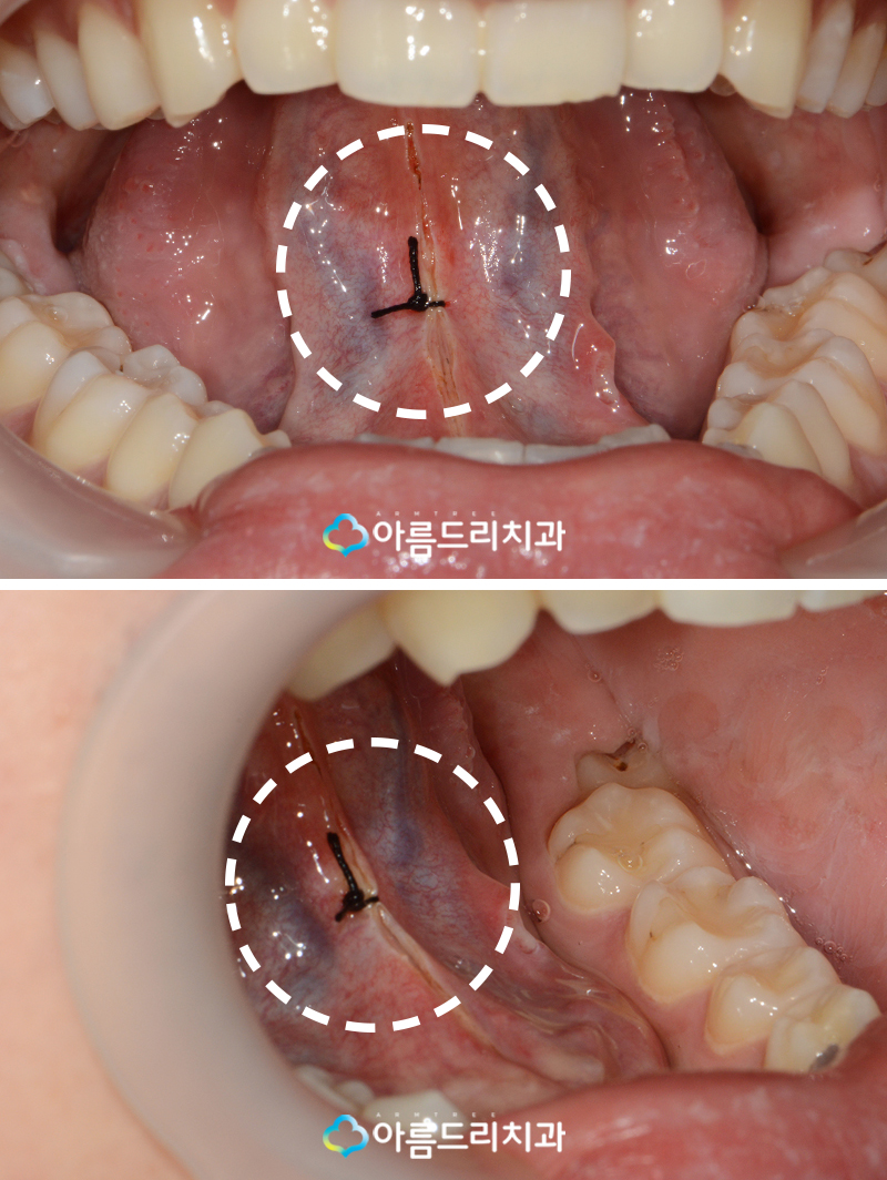 설소대수술 - 실제후기로 보는 확연한 차이 관련 이미지 8
