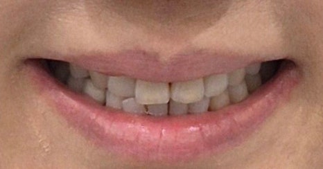 테일러 비니어 (진료일기) 관련 이미지 5