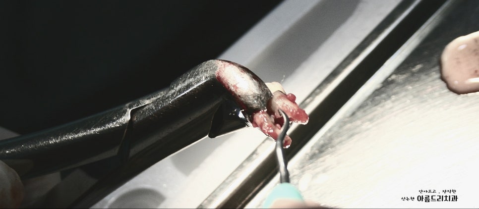 치아재식_임플란트 안 하고 치아 살릴 순 없나요?(신논현역 치과) 관련 이미지 8