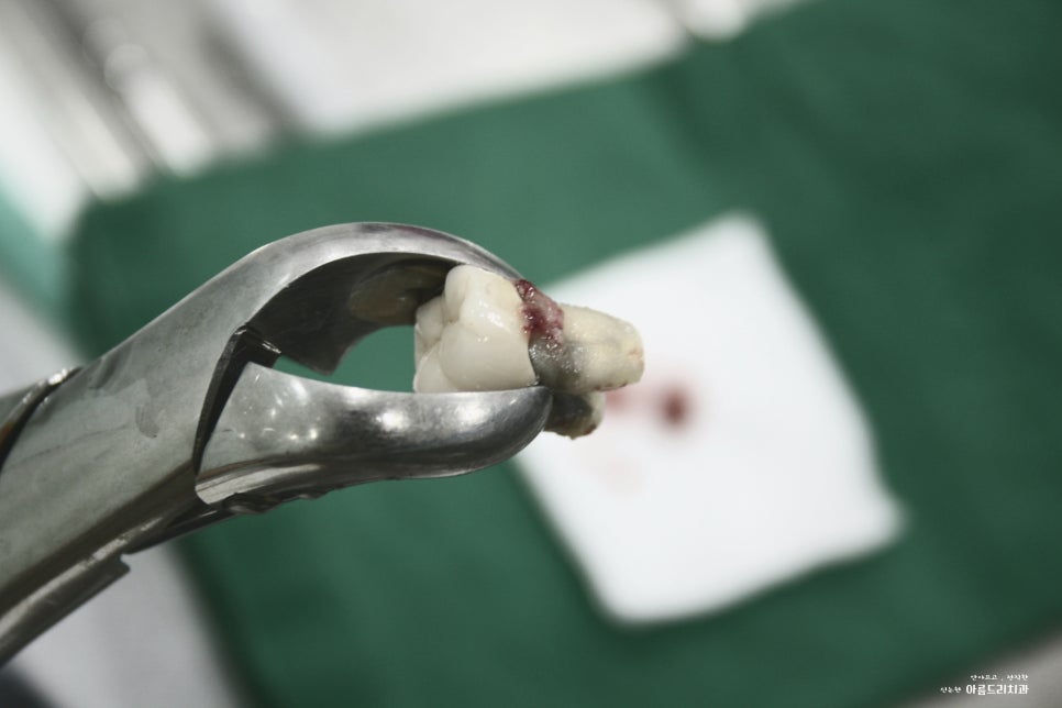 치아재식_임플란트 안 하고 치아 살릴 순 없나요?(신논현역 치과) 관련 이미지 20