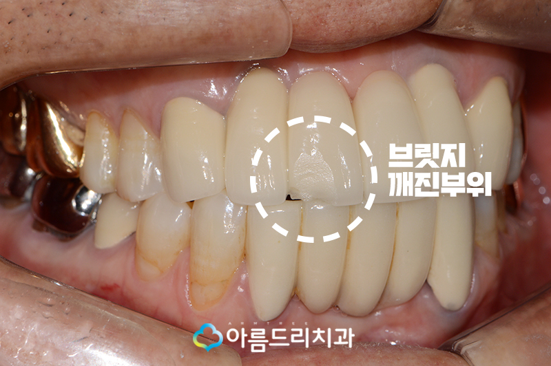 앞니 브릿지가 깨졌어요 치과치료 관련 이미지 4