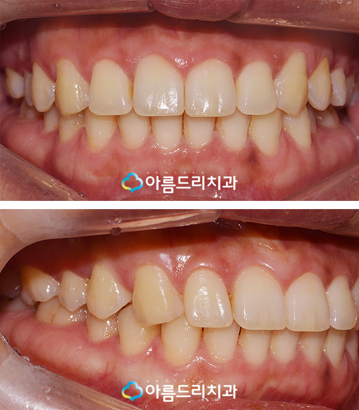 앞니벌어짐 부분교정으로 빠르게 관련 이미지 7