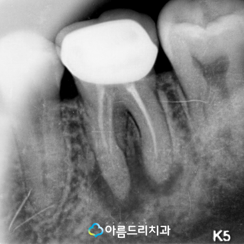 잇몸고름주머니 잇몸에고름 치아재식술 치료 관련 이미지 3