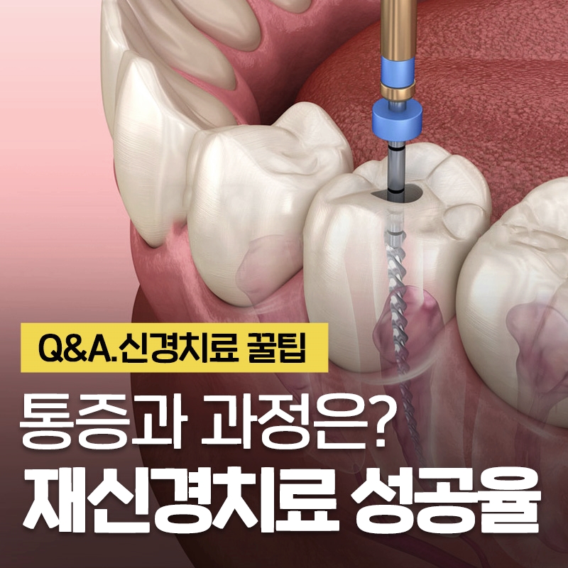 치아 재신경치료 성공율 과정과 통증 #이현정의물음표 관련 이미지 1