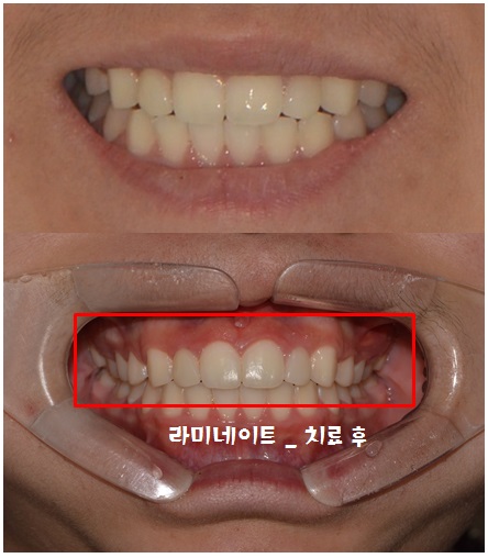 앞니 라미네이트_왜소치아 (최소삭제) 관련 이미지 3