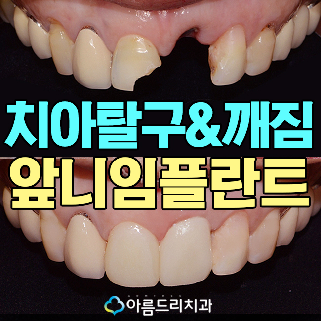 치아탈구(깨짐) 앞니임플란트 지르코니아어버트먼트 관련 이미지 1