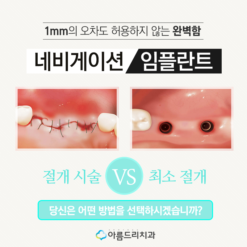 네비게이션 인플란트 기간은 어떻게? 관련 이미지 4