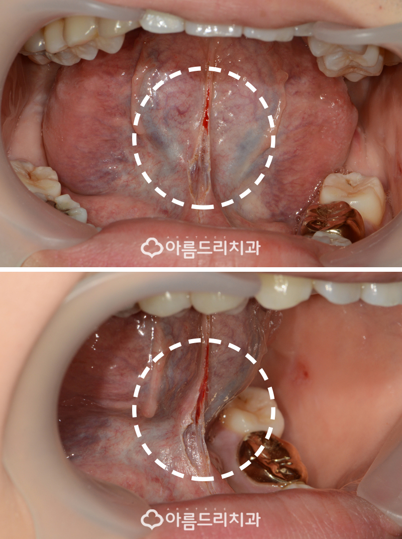 성인 설소대수술 비용 리얼후기 관련 이미지 8