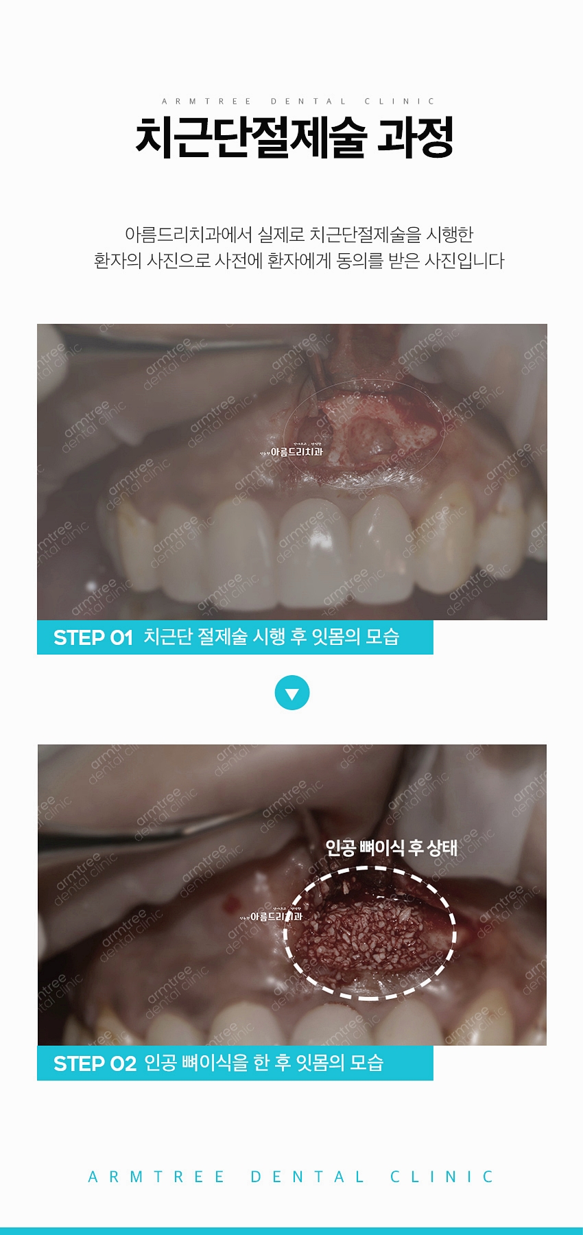치근단절제술 염증 신뢰있는 후기 아름드리치과 관련 이미지 9