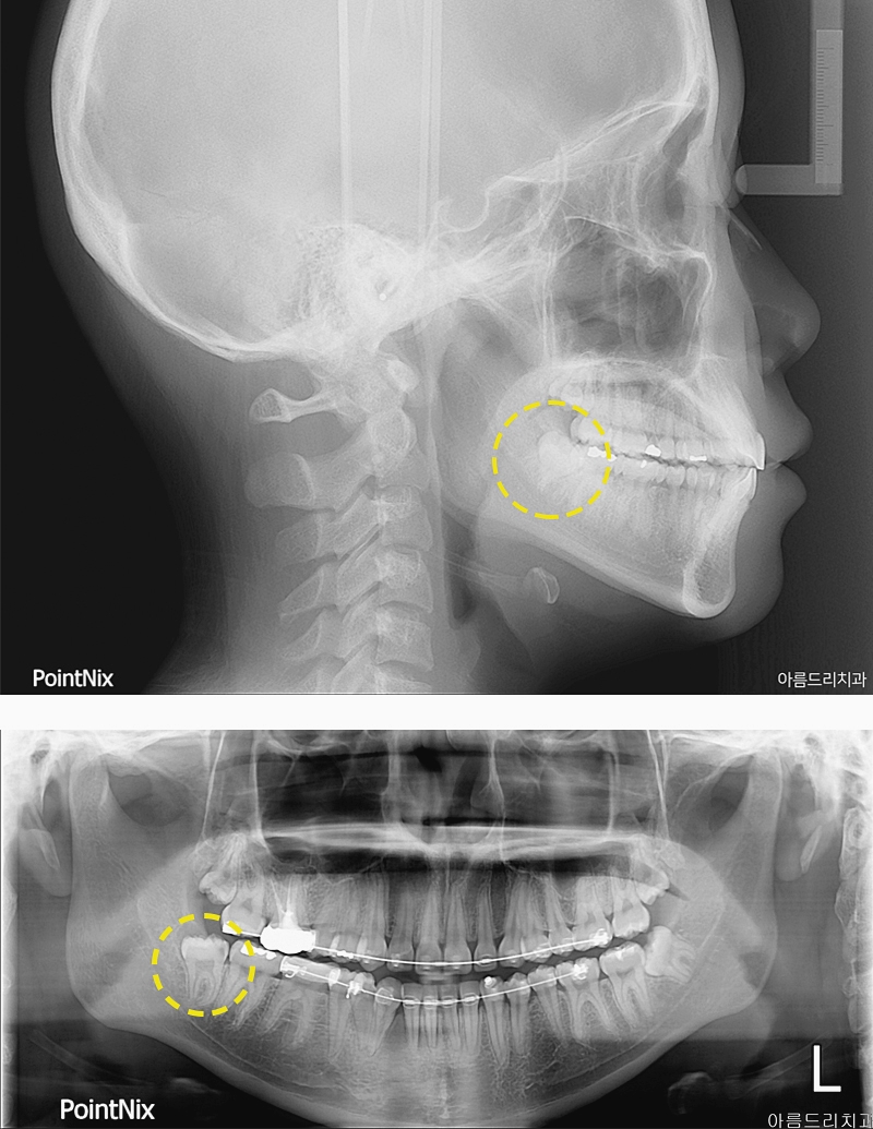 매복사랑니 발치후기통증 아름드리치과 관련 이미지 2