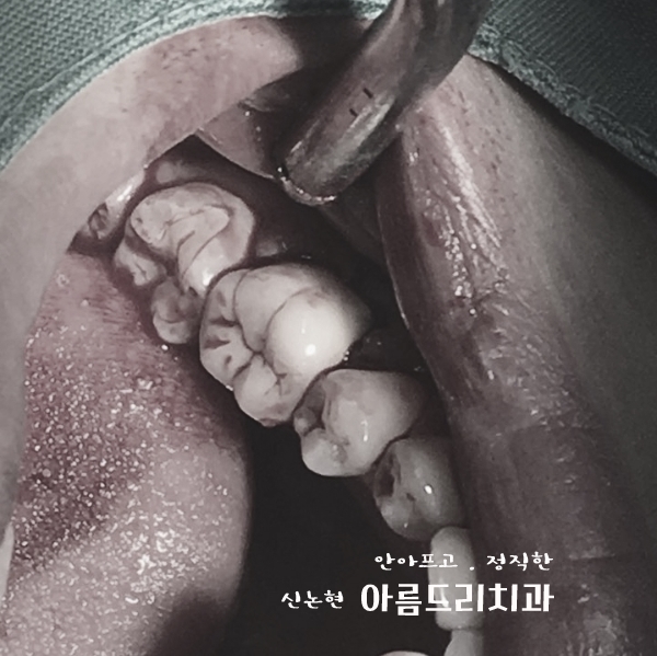 치아재식_임플란트 안 하고 치아 살릴 순 없나요?(신논현역 치과) 관련 이미지 23