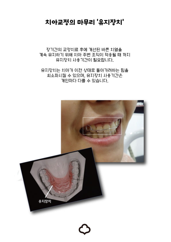 교정 완료_유지 장치 어떤 거 해야 해? 관련 이미지 1