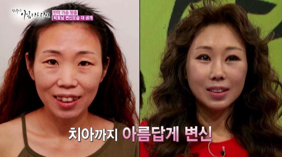 이현정원장의 아름다운 당신 시즌 1(4회 박효남 도전자) 돌출입 치아교정 관련 이미지 9