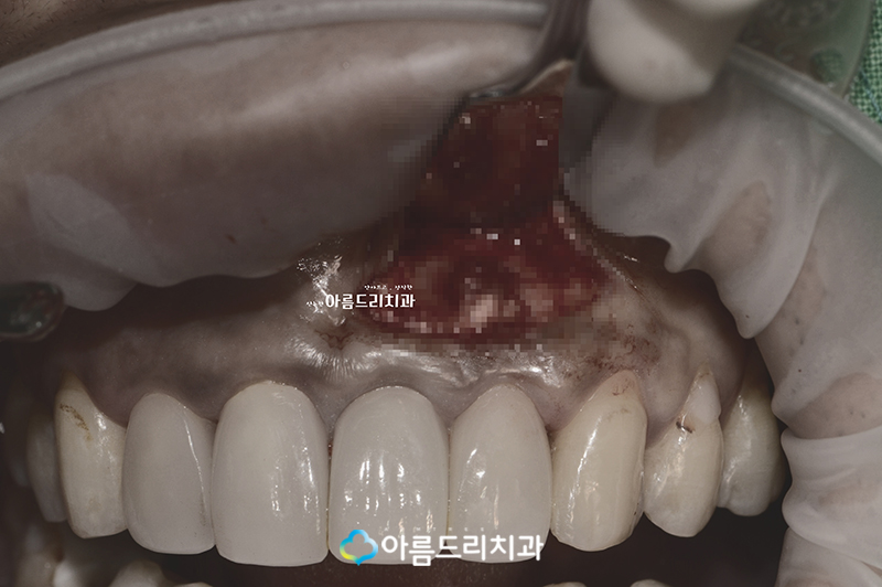 치근단절제술 수술후기 자연치아 살리기 관련 이미지 4