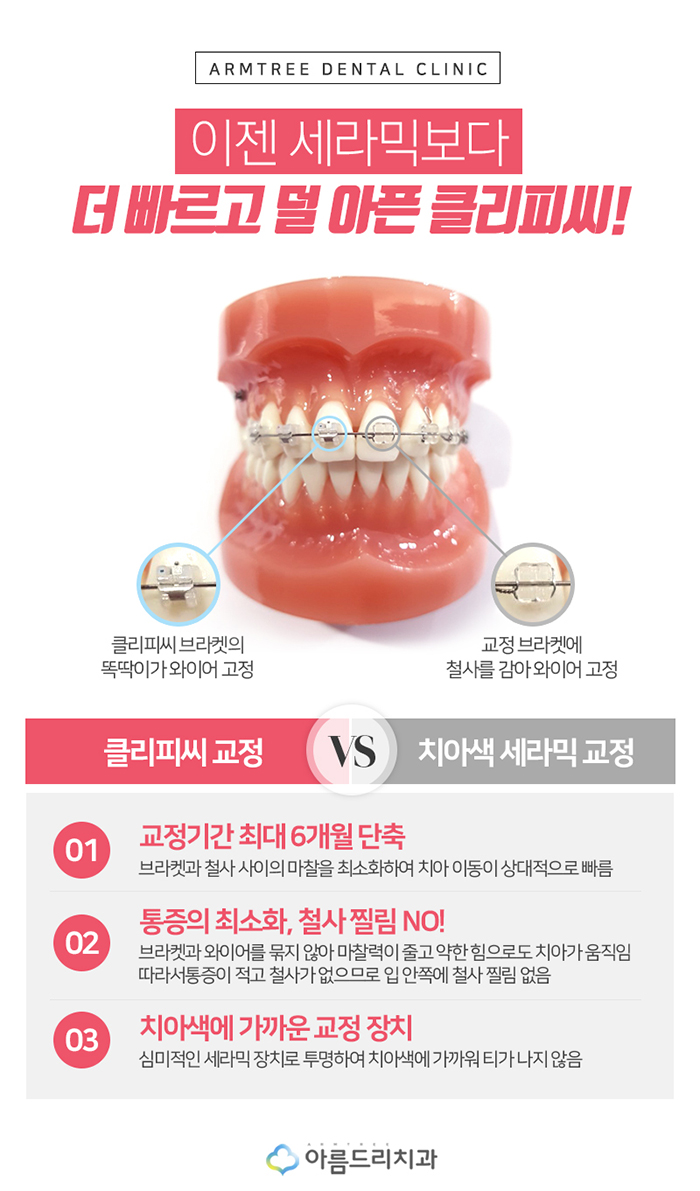 클리피시교정 덜아프고 빠르게 관련 이미지 4