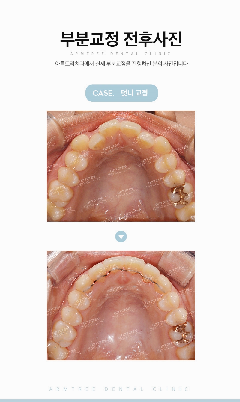 덧니부분교정 앞니송곳니는 아름드리치과 관련 이미지 12
