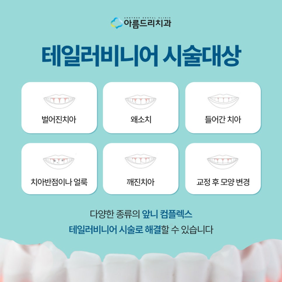 강남 연예인들이 많이 찾는 치아성형 자연스러운 무삭제 라미네이트 치아성형 관련 이미지 4
