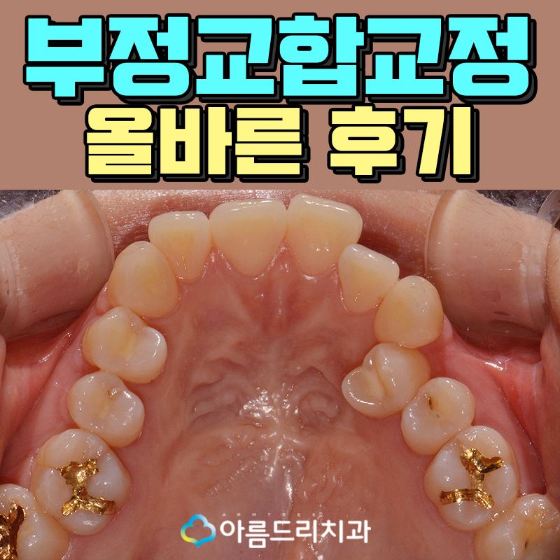 치아부정교합교정 악궁확장장치 후기는? 관련 이미지 1