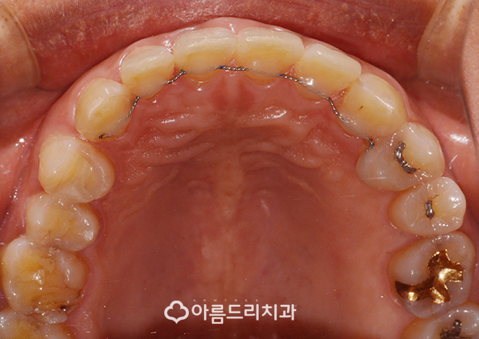 앞니 벌어짐 교정 빠른해결책 관련 이미지 5