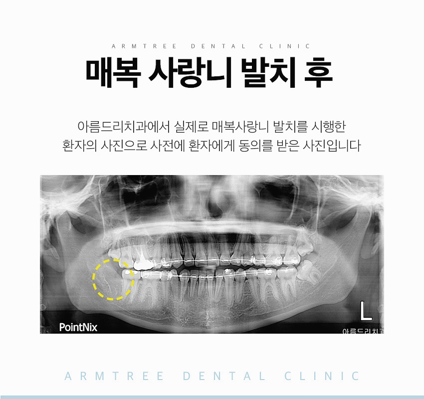 매복사랑니 발치후기 통증없는 아름드리치과 관련 이미지 10