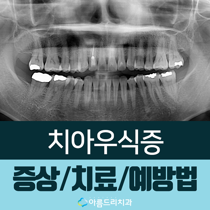 치아우식증 치료 증상과 예방법 관련 이미지 1