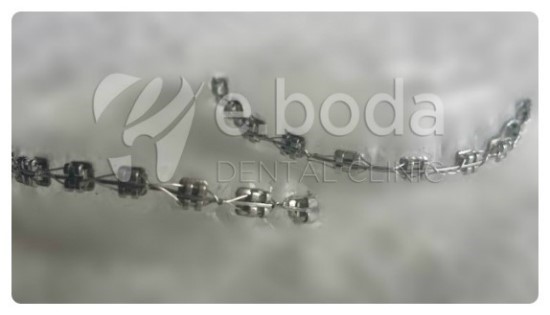 응답하라1988교정기녀 미옥이의 교정 이야기 관련 이미지 6