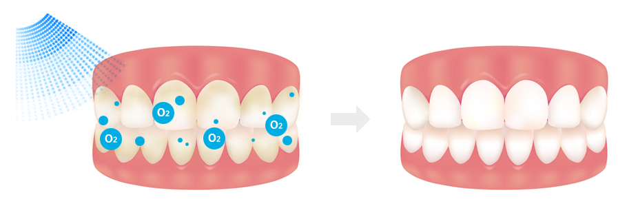 치아미백 꼭 알아야 하는 주의사항 확인하세요 관련 이미지 4