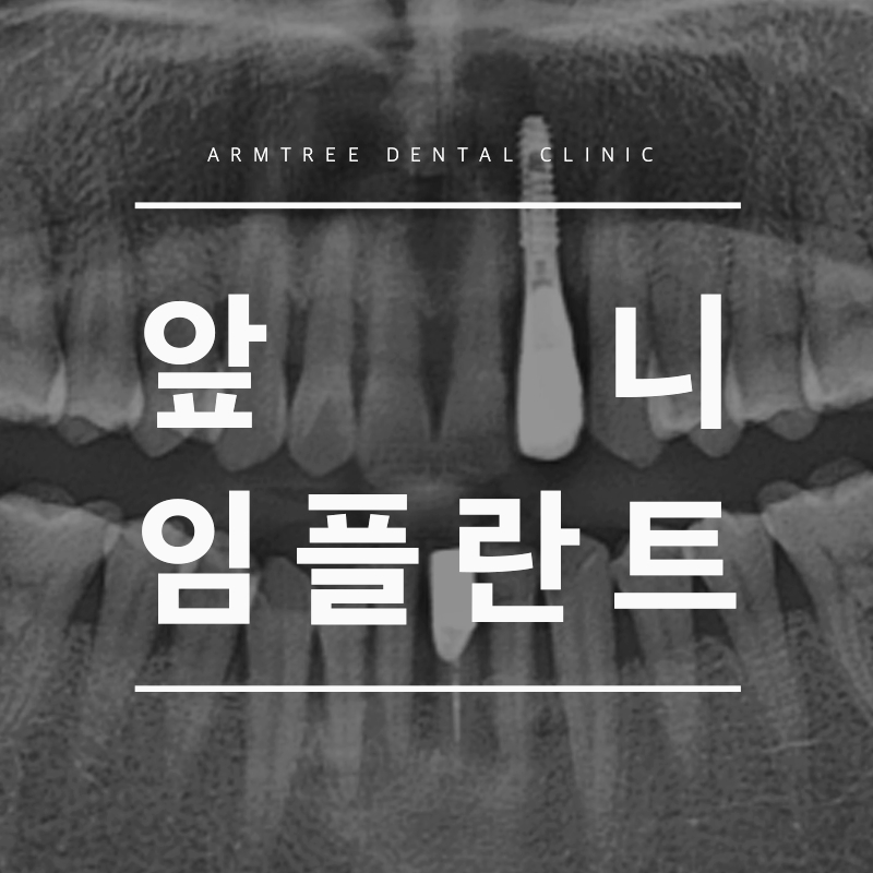 신논현 앞니임플란트 심미성이 중요하다면 관련 이미지 1