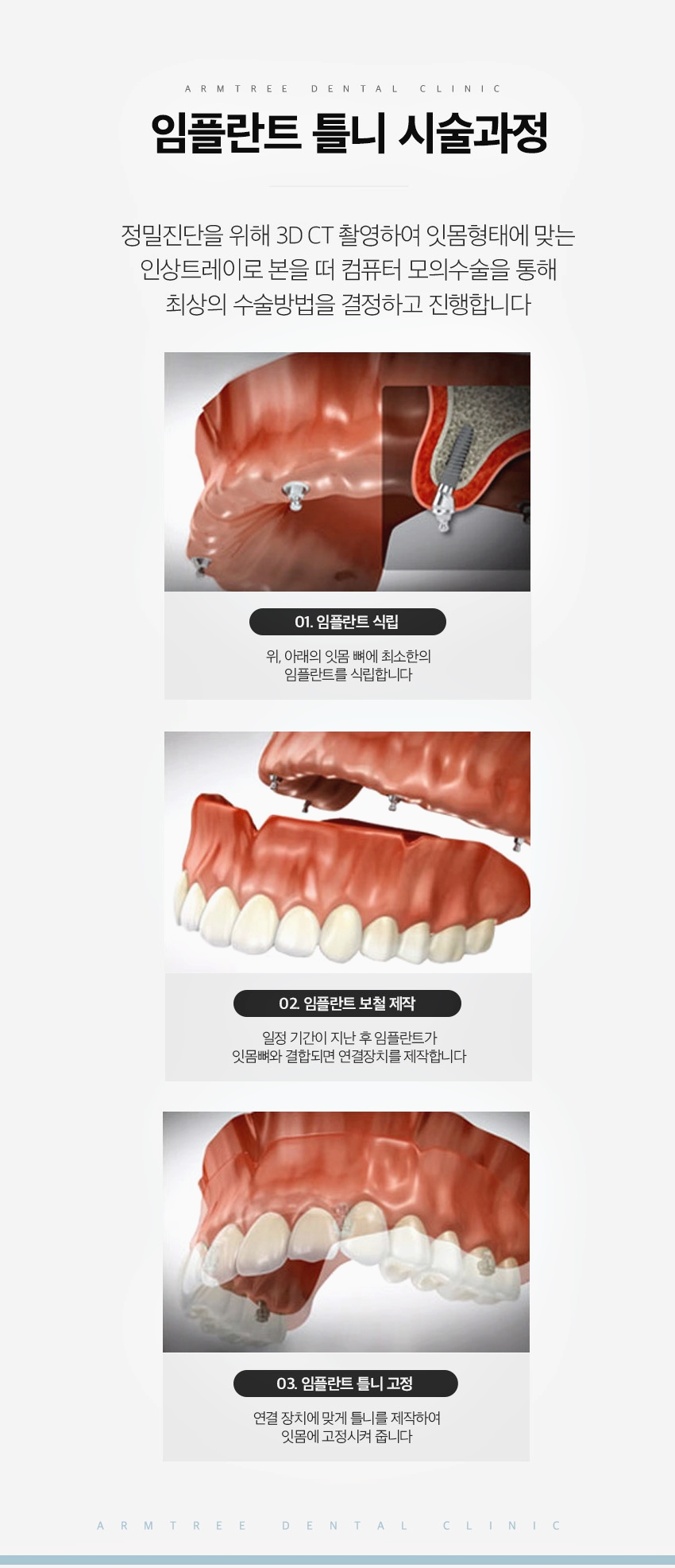신논현치과 임플란트틀니로 치료부담을 줄인다면 관련 이미지 5
