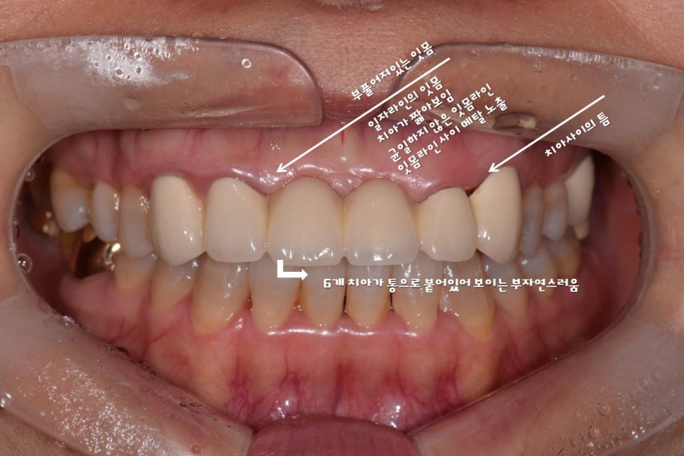 앞니 크라운 재치료 & 잇몸성형 _건강하게 . 예뻐지는 방법 관련 이미지 4