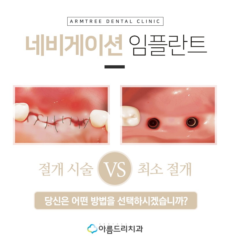 인플란트통증 디지털임플란트 좋은이유 관련 이미지 4